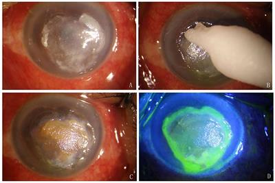 Local application of silver nitrate as an adjuvant treatment before deep lamellar keratoplasty for fungal keratitis poorly responsive to medical treatment